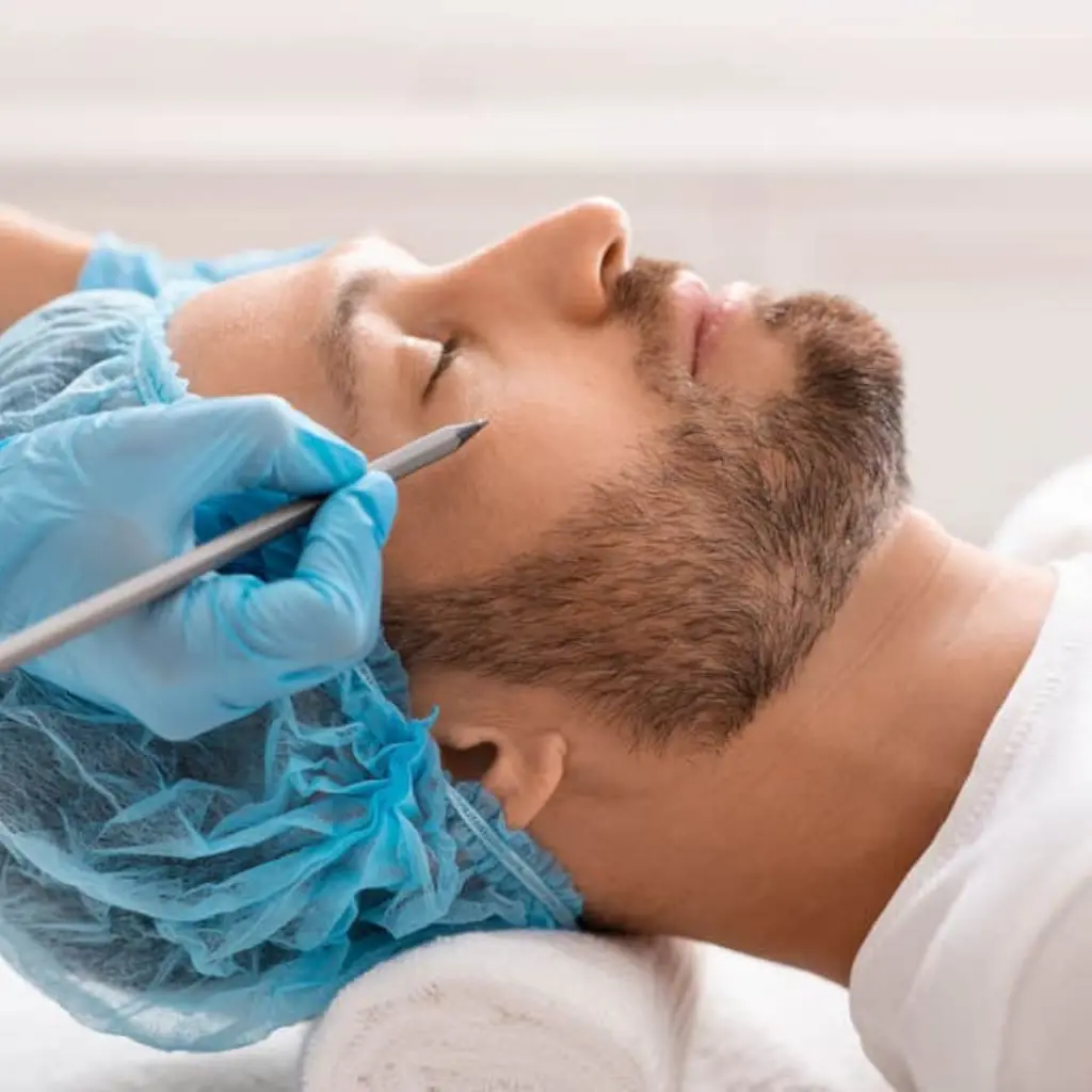 Collage con tres casos clínicos reales de bichectomía en hombres, comparando el antes y después para mostrar la definición del rostro.