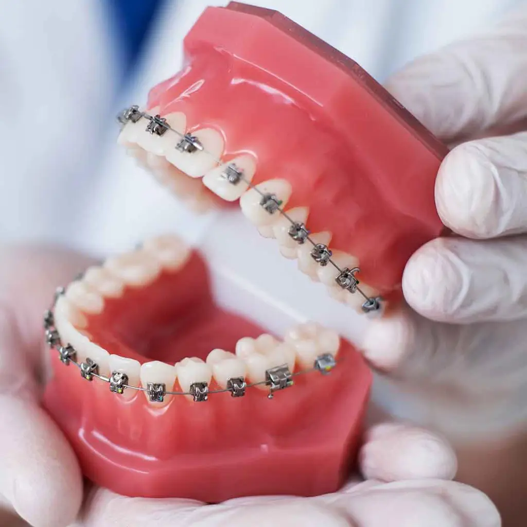 Sonrisa de una mujer joven con brackets estéticos, mostrando los excelentes resultados de un tratamiento de ortodoncia profesional en Ecosalud.