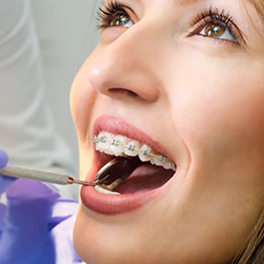 Mujer joven sonriendo con instalaci贸n de brackets cer谩micos transparentes durante una revisi贸n dental en la cl铆nica Ecosalud.