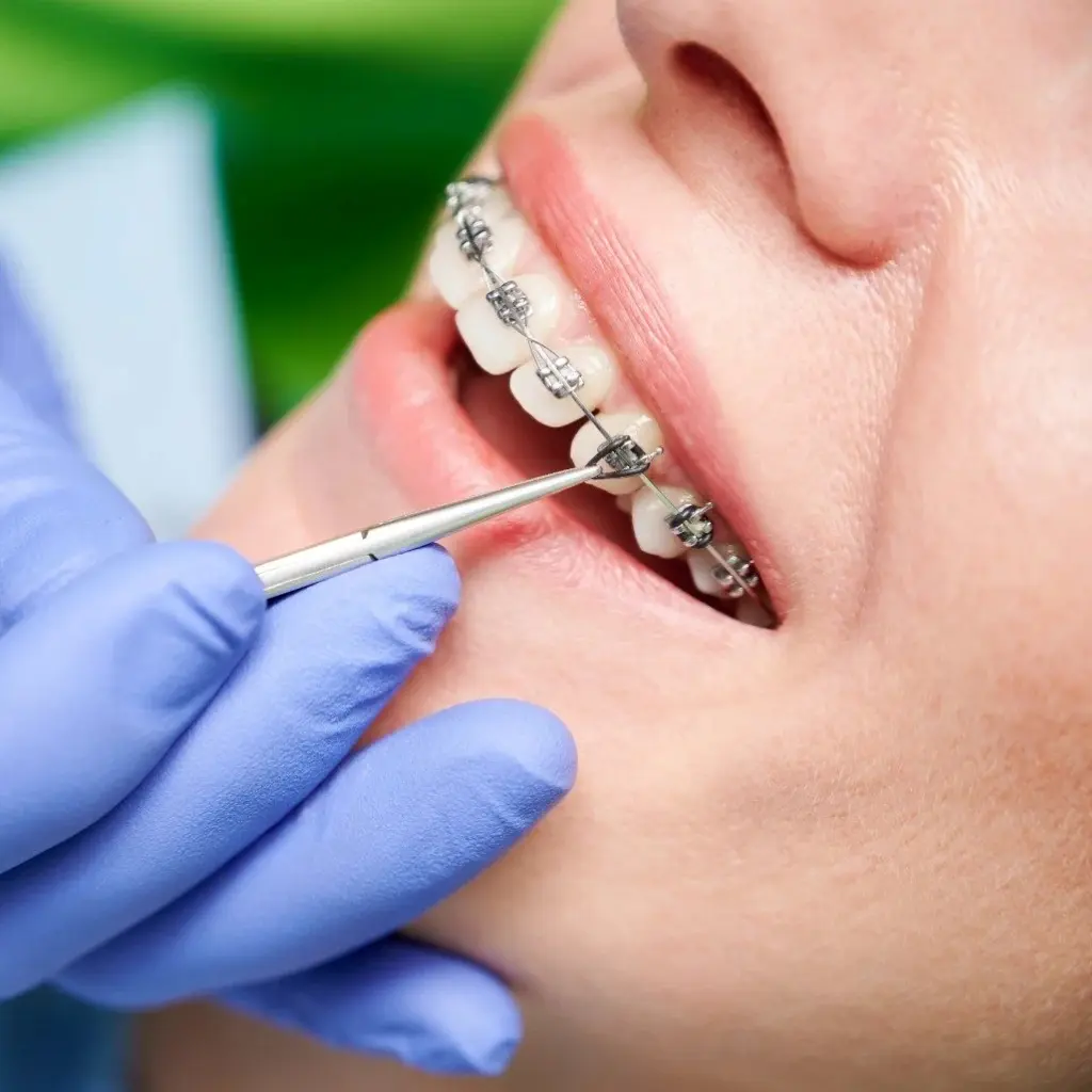 Paciente sonriendo mientras un ortodoncista realiza la instalaci贸n de brackets met谩licos en la cl铆nica Ecosalud.