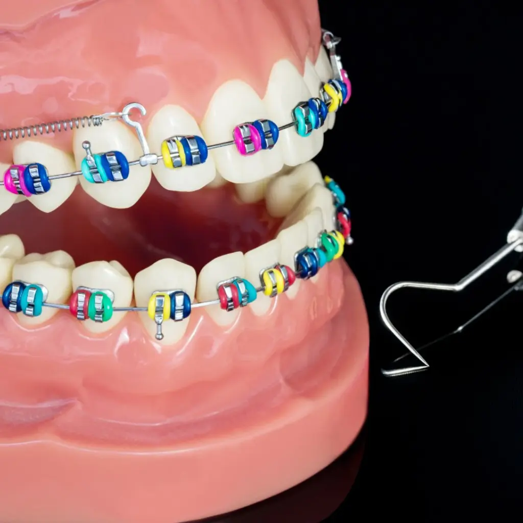 Modelo dental con brackets estéticos de colores y herramientas de ortodoncia sobre fondo oscuro, ilustrando un tratamiento de brackets estéticos