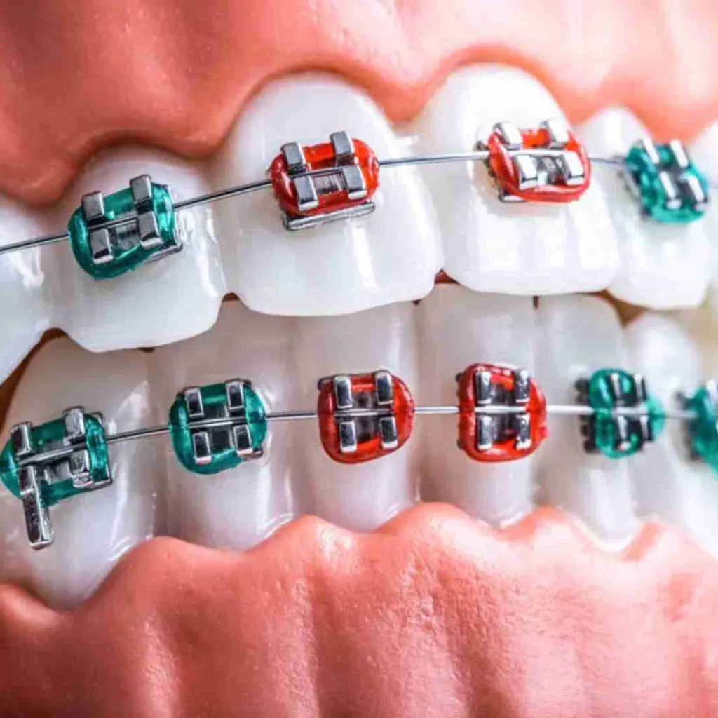 Sonrisa de una paciente joven con un tratamiento de ortodoncia convencional para corregir la alineación de sus dientes