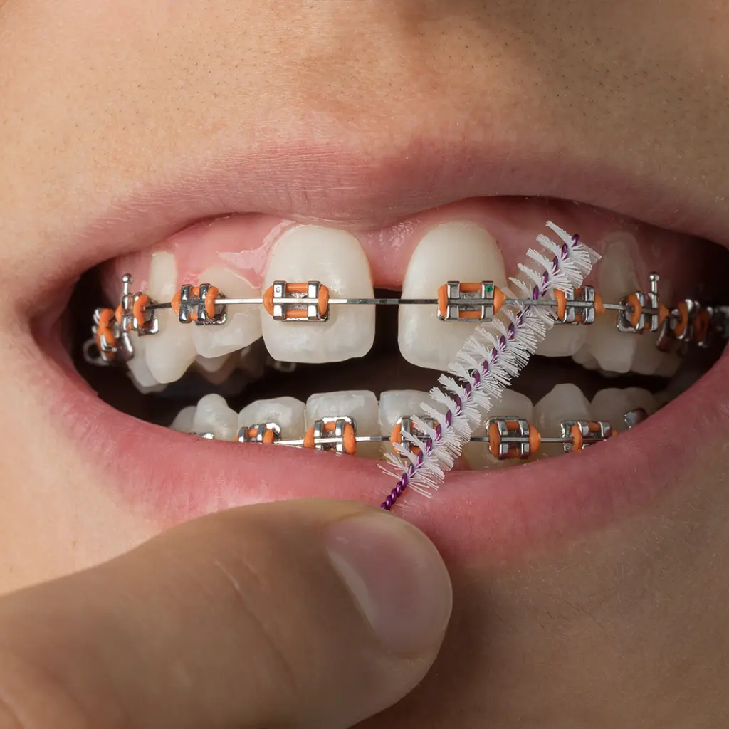 Primer plano de una sonrisa perfecta con brackets estéticos de zafiro, mostrando una solución de ortodoncia discreta y eficaz.