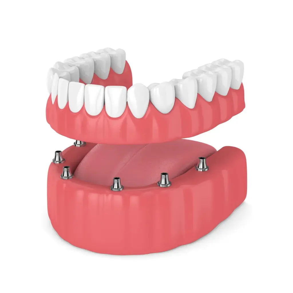 Estructura de una prótesis dental mostrando los tornillos de fijación a los implantes en la encía.