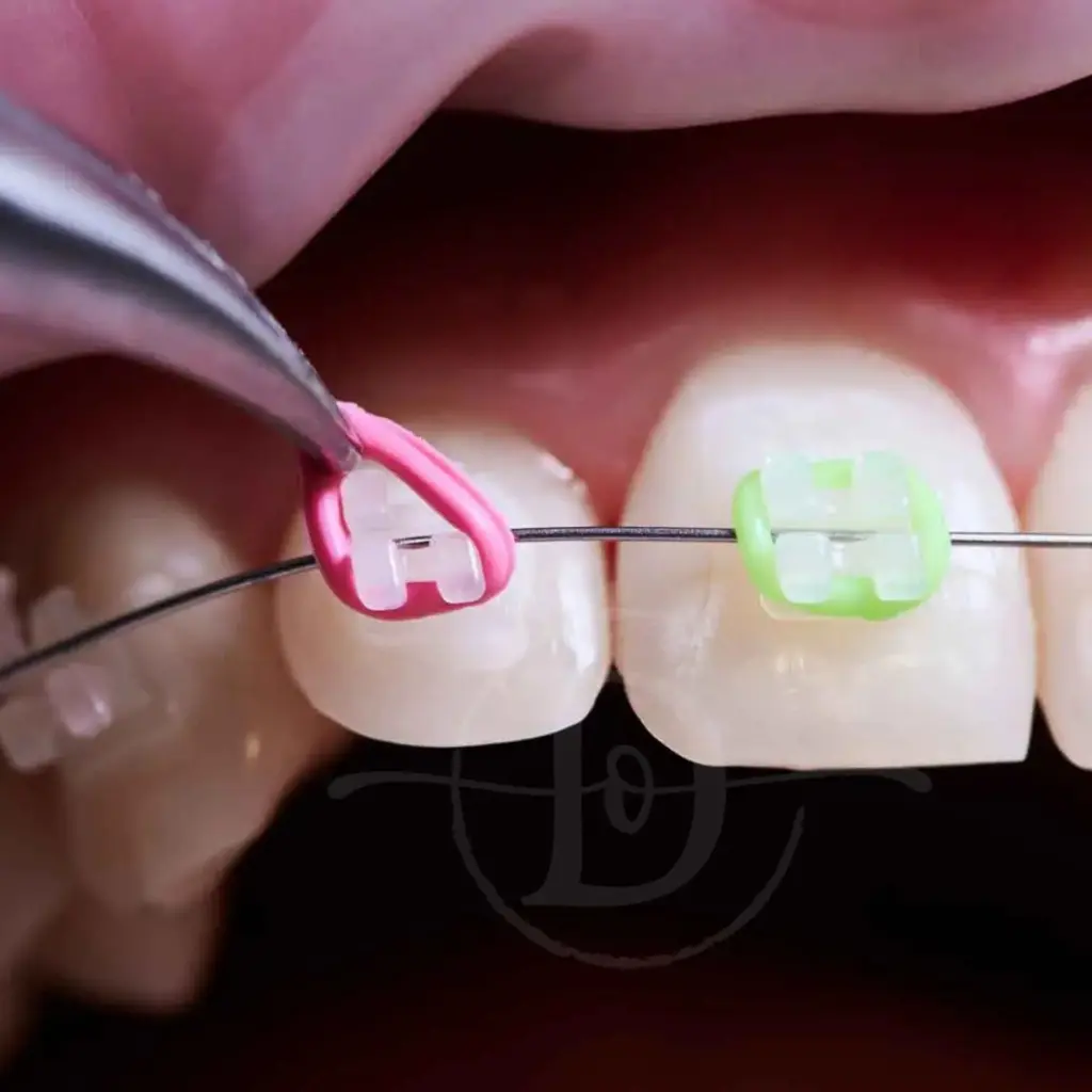 Banner del tratamiento de ortodoncia en Ecosalud Santiago, mostrando a una mujer con una sonrisa perfecta y el texto "Sonrisas que enamoran"