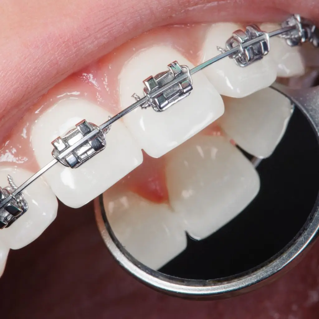 Imagen de cerca de una boca abierta con ortodoncia brackets metálicos en los dientes superiores