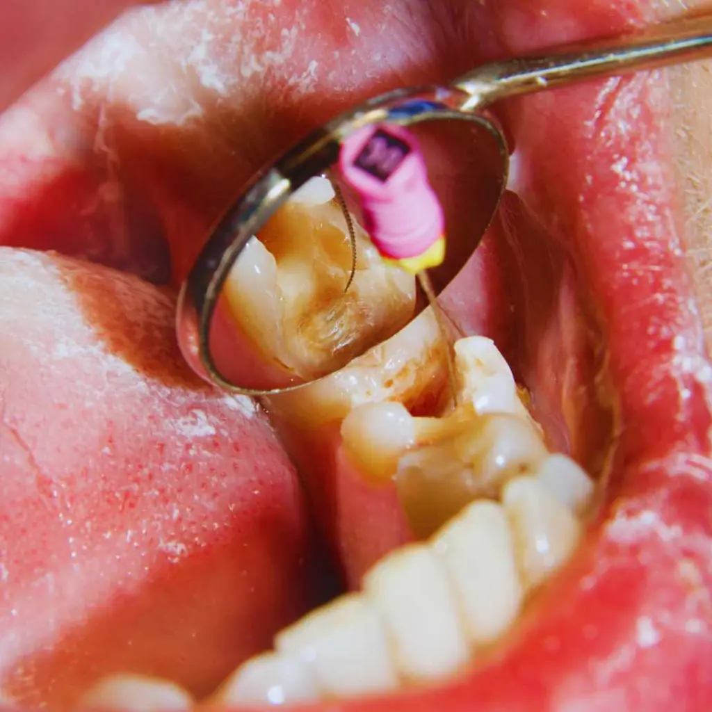 Paciente recibiendo un tratamiento de endodoncia dental por una especialista de Ecosalud para salvar su diente y eliminar el dolor.