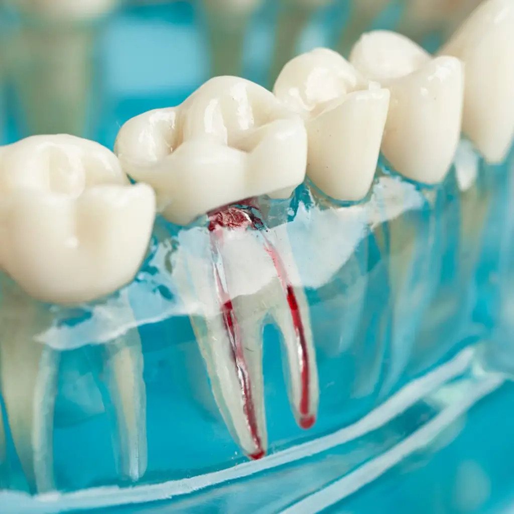 Especialista de Ecosalud explicando en una maqueta dental por qué es necesaria una endodoncia en una muela para tratar la pulpa infectada.