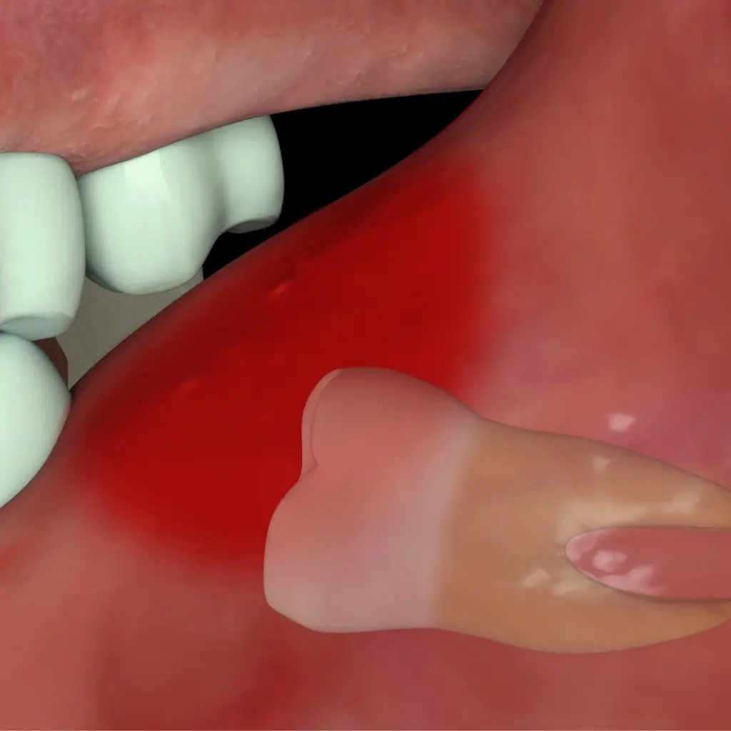 Hombre con dolor agudo por una muela del juicio que requiere una extracción dental urgente