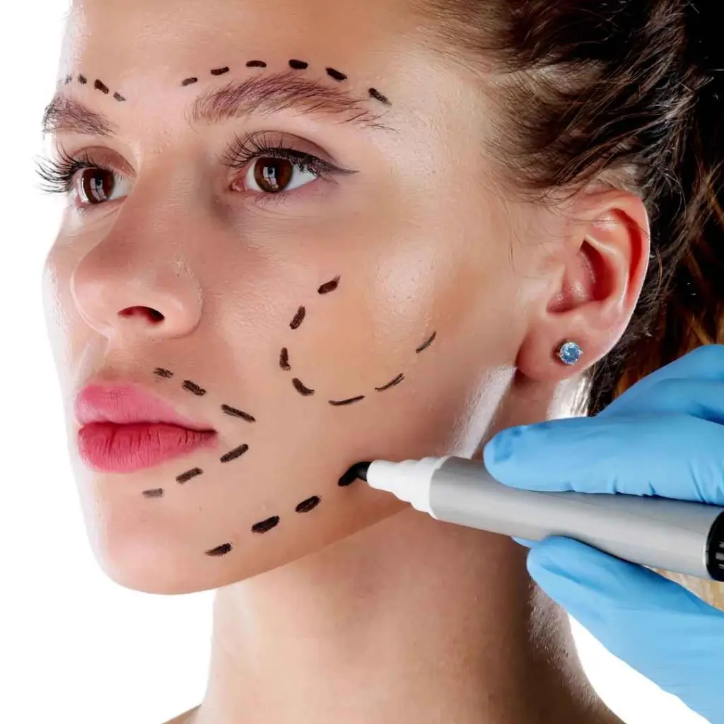 Un experto médico marcando puntos en el rostro de una mujer joven para un procedimiento de bichectomía y perfilado facial.