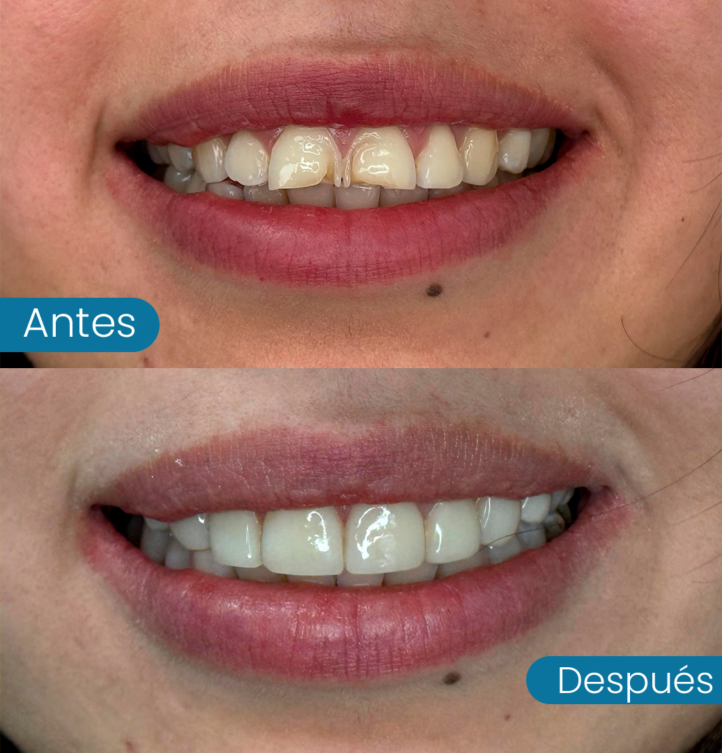 Diseño de sonrisa clínica dental Santiago