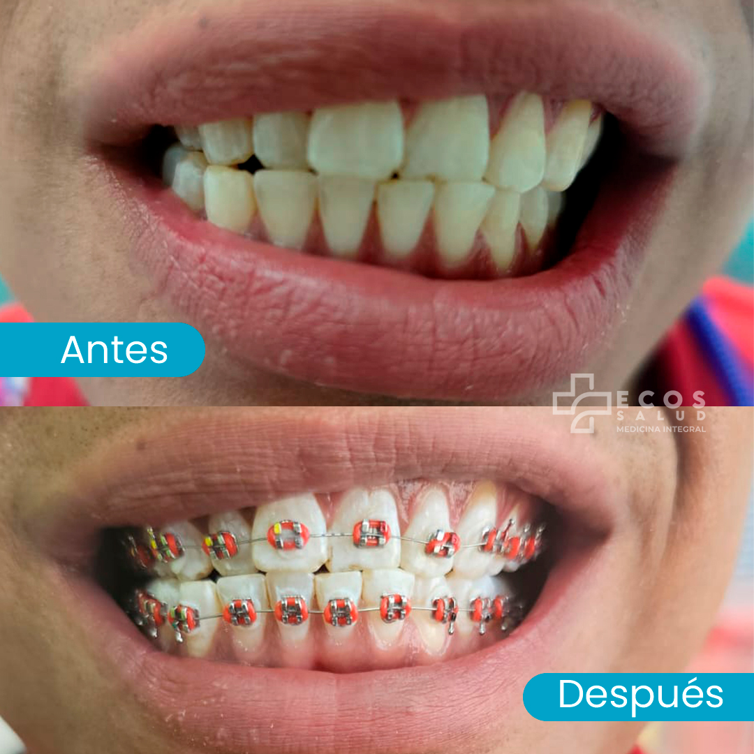 Detalle de brackets metálicos utilizados en ortodoncia