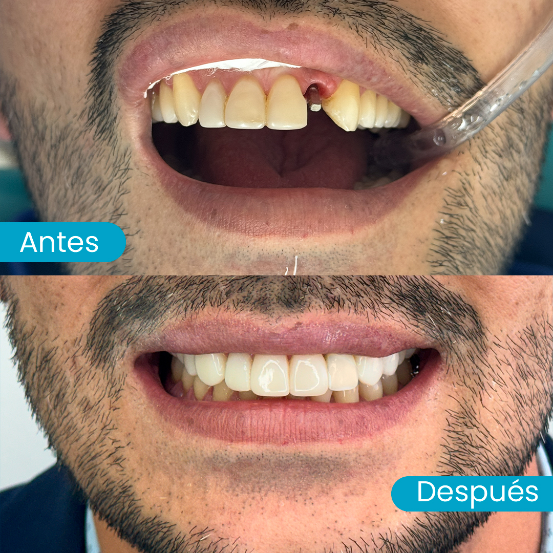 Resultado de tratamiento con implantes dentales en Santiago
