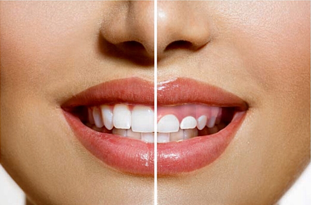 Gingivectomía en clínica dental de Santiago