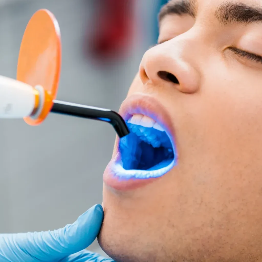 Resultados de blanqueamiento dental con LED