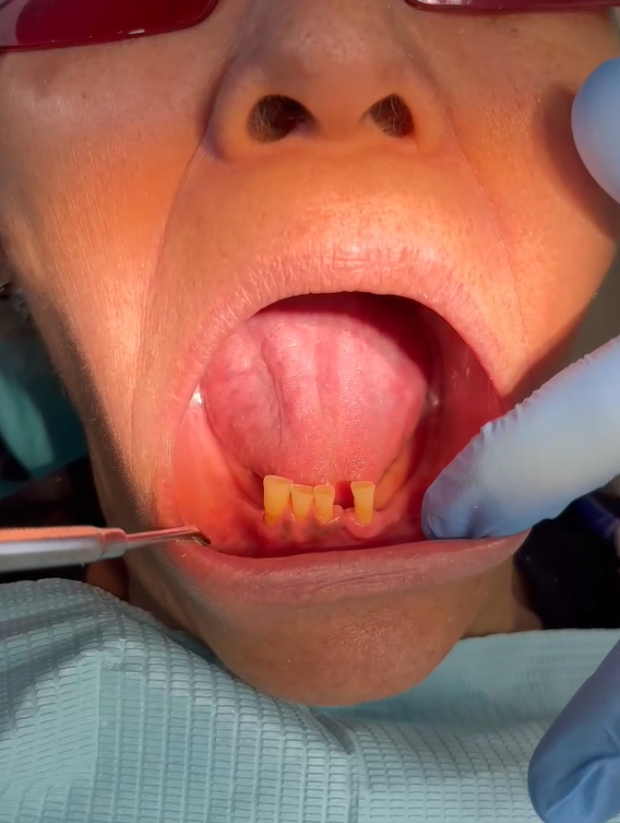 Antes y después prótesis Valplast en paciente en Santiago