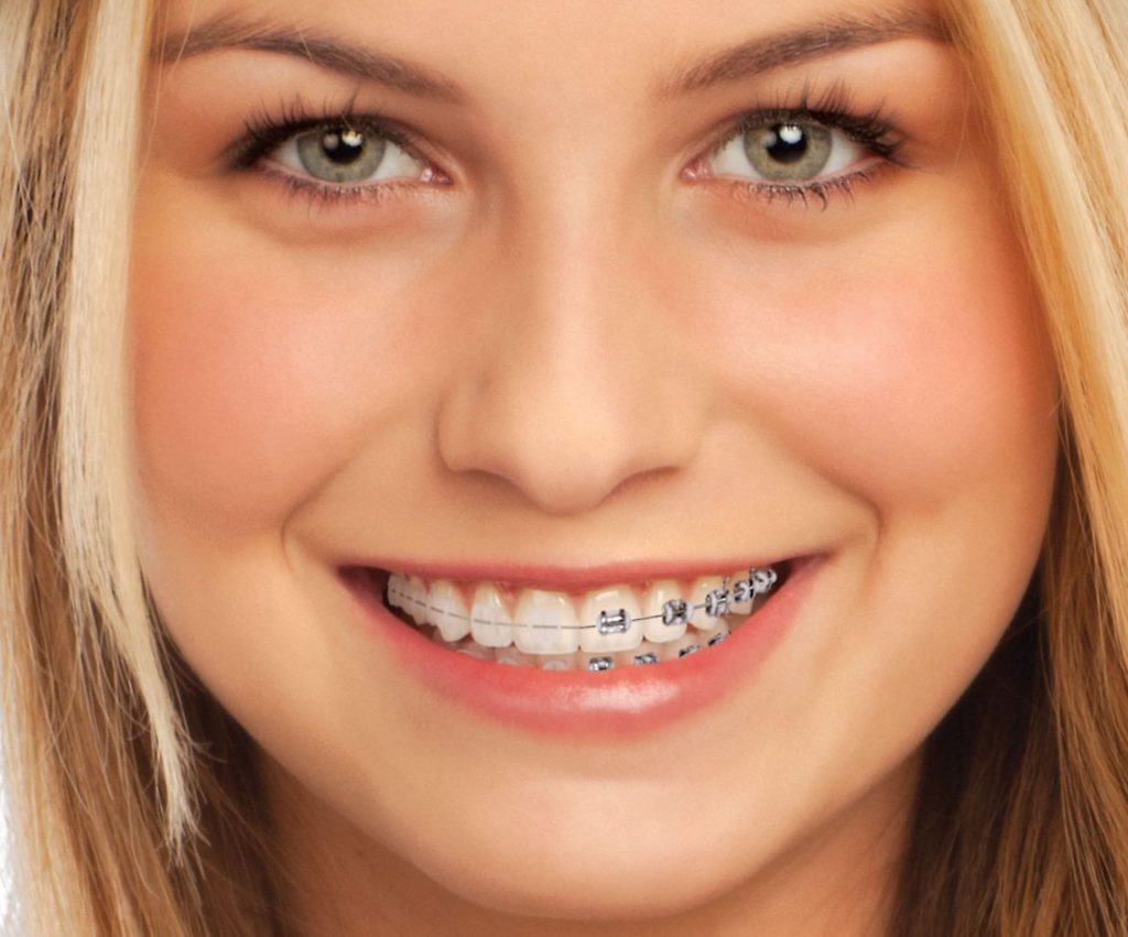 Resultado de ortodoncia estética con brackets cerámicos