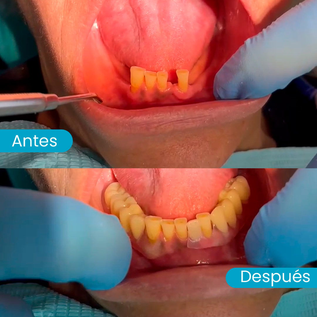 Paciente con prótesis Valplast en Santiago resultado natural